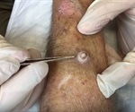 Keratoacanthoma Overview