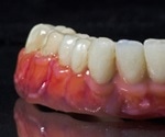 Dental Bridges - Advantages and Disadvantages