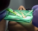 Root Canal Treatment Procedure