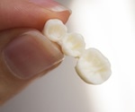 Dental Bridge Procedure