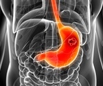 Early detection of stomach cancer shows major progress