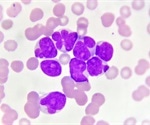 HLA-DRB1 molecule can be a potential target in treating acute myeloid leukemia