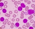 Immunoglobulin replacement therapy not associated with reduced risk of serious infections in patients with CLL