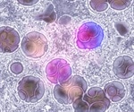 Leukemia-on-a-chip offers breakthrough in personalized cancer treatment