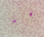 Early-warning blood biomarkers identified for lung damage