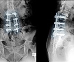 Facilitating Bone Repair with Bioactive Glass Bone Grafts
