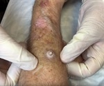 Keratoacanthoma Diagnosis