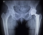 Coating Implants with Bioactive Glass to Promote Implant Fixation