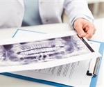 Dentigerous Cysts