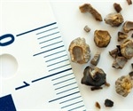 Ureteric Calculi Research