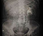 Ureteric Calculi Prognosis