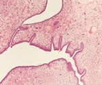 Radiotherapy and Chemotherapy for Phyllodes Tumors