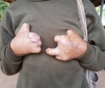 Genetic analysis shows leprosy was endemic in pre-colonial America