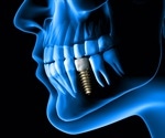 3D printed bone scaffolds successfully used to rebuild jawbone