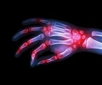 Immune molecule found to play a key role in regulating inflammation in rheumatoid arthritis