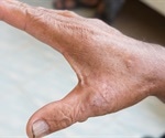 New 3D tissue model offers hope for scleroderma treatment