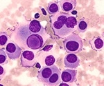 Common autoimmune drug shown to help patients with giant cell arteritis