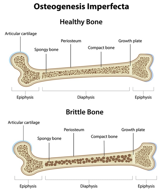 Osteogenesis Imperfecta - Image Credit: joshya / Shutterstock