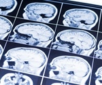 Headband meditation may offer pain relief and improved function after Cushing's surgery