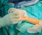 Causes of Webbed Fingers and Toes