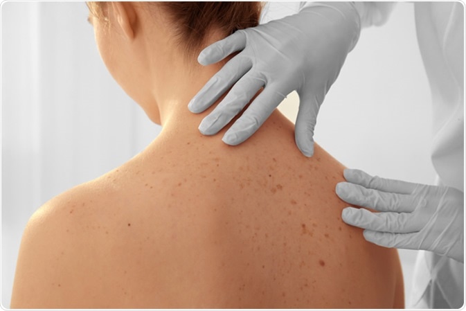 Mole Mapping, dermatologist examining patient in clinic, closeup. Image Credit: Africa Studio / Shutterstock