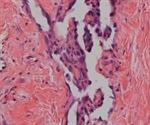 Angiosarcoma Symptoms and Causes