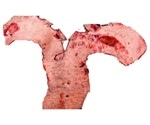 Study: Liver inflammation increases cholesterol levels in people with diabetes