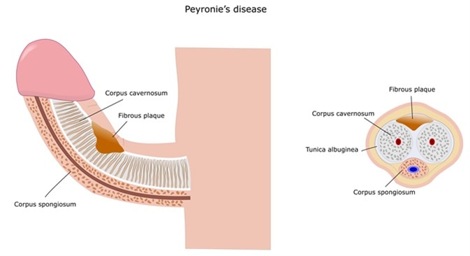 Peyronie