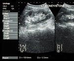 Kidney Stones: Symptoms and Causes