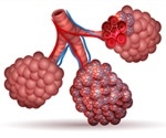 Walking Pneumonia versus Pneumonia