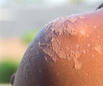 Sun Exposure - Positive and Negative Effects