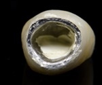 Dental Crown Complications