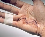 Dupuytren's Contracture Surgery and Recovery