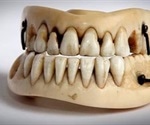 History of Dental Implants