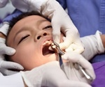 Types of Dental Extraction