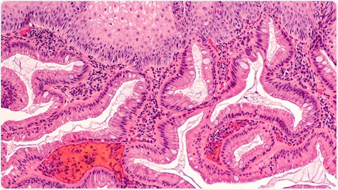 Intestinal (Barrett