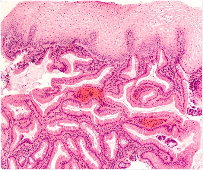 Intestinal (Barrett