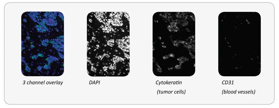 distancetumor