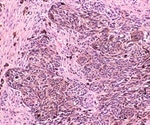 Role of Tumor-Associated B Cells in Tumor Heterogeneity and Therapy Resistance