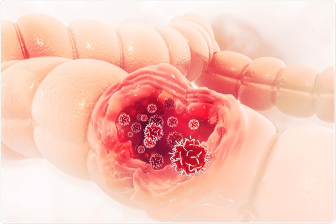 Colorectal cancer - by crystal light