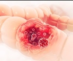 Colorectal Sarcoma