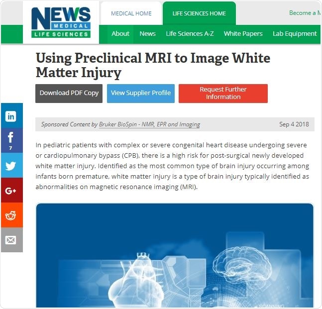 White Matter Injury Article Example White Matter Injury Article Example
