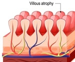 World’s first vaccine against coeliac disease to be tested in Australia