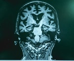 Does Type 2 Diabetes Increase the Risk of Alzheimer’s Disease?