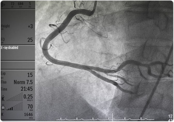 Coronary angiography. Image Credit: Pitchyfoto / Shutterstock