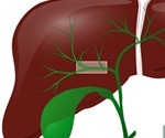 What is Acute Cholangitis?
