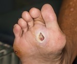 Diabetes and Wound Healing