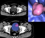 Bladder Cancer Genomics