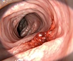 Colorectal Cancer Pathogenesis