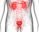 Muscle Invasive Bladder Cancer (MIBC)